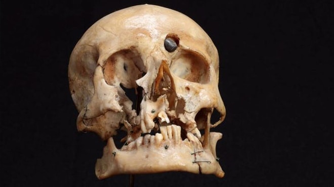 The skull of Pvt. Thomas Hurdis.